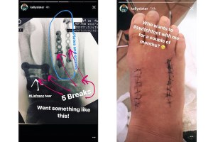 OPERASI KAKI KELLY SLATER BERJALAN DENGAN BAIK